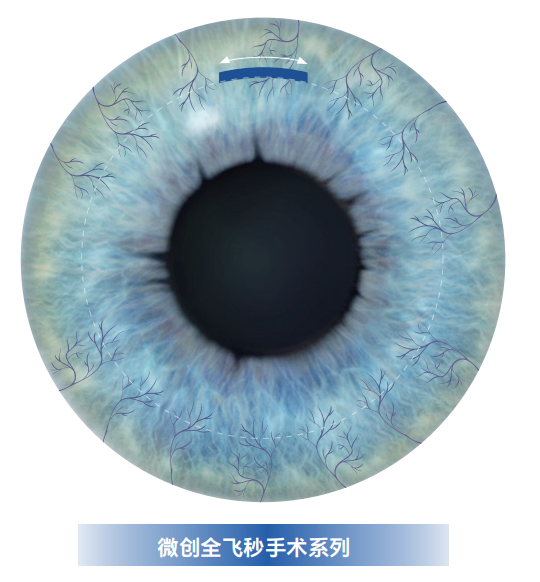 一文读懂:新一代全飞秒smile pro如何轻松告别近视